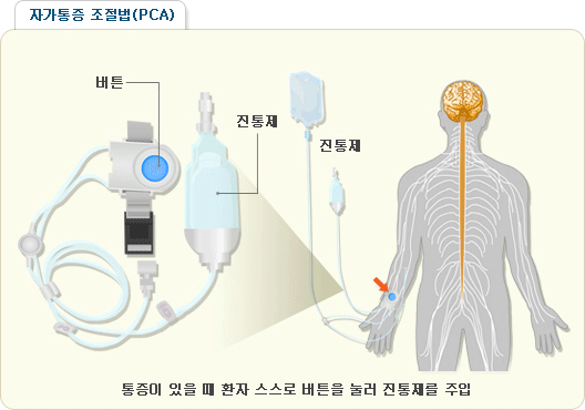 자가통증 조절법(PCA) - 통증이 있을때 환자 스스로 버튼을 눌러 진통제를 주입