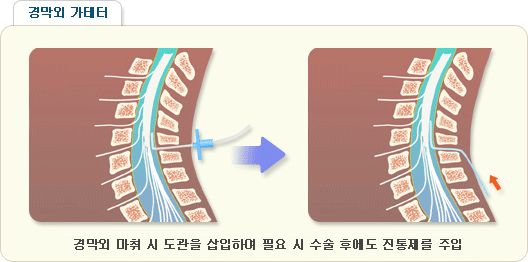 경막외 가데터 - 경막외 마취 시 도관을 삽입하여 필요 시 수술 후에도 진동제를 주입