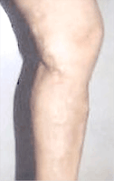 복재정맥류
